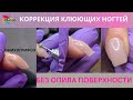 Коррекция клюющих ногтей без опила поверхности/ Онихогрифоз