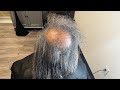 Her bald spot is growing back | How we grew her hair back| Adrogenetic Alopecia regrowth