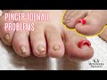 Pedicure tutorial on pincer toenails that cause pain