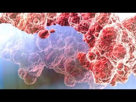 Video: Léčba BCG U Rakoviny Močového Měchýře: Co Očekávat