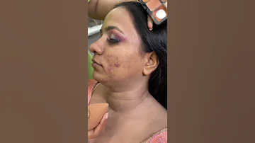 Acne Prone Skin Makeup 