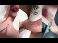 12 Minutes Of ASMR Pimple Popping Video