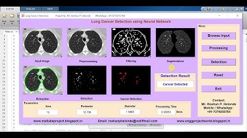 Lung Cancer Detection using Neural Network Matlab Project with Source Code | Lung Cancer Prediction