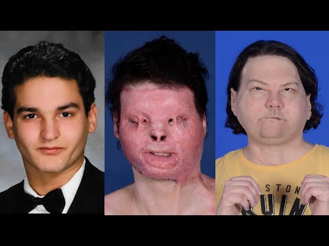 Video: Gesichtstransplantation: Ein Einwohner Frankreichs Unterzog Sich Zwei Einzigartigen Operationen - Alternative Ansicht