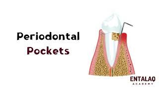 Periodontal Pockets: Causes, Treatment, and Prevention | الاسباب والعلاج