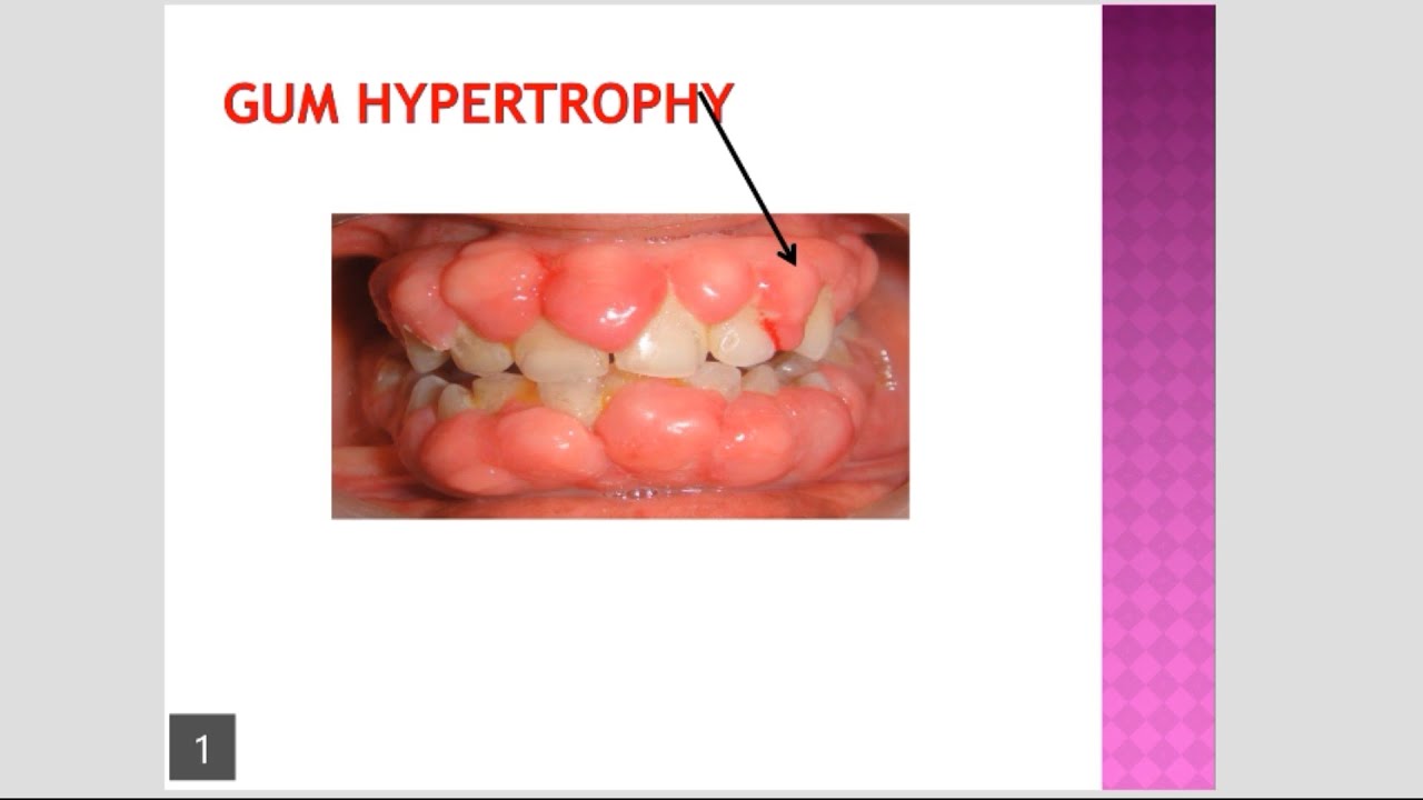 Gingival Hyperplasia With Calculus gingival-hyperplasia-with-calculus