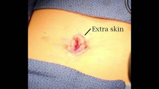 Umbilicoplasty Quick Video Umbilicoplasty Quick Video