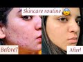 SKINCARE ROUTINE FOR ACNE/ACNE PRONE SKIN | How to get rid of acne