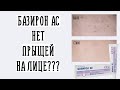 Базирон АС нет ПРЫЩЕЙ на ЛИЦЕ? | Мой опыт борьбы с прыщами