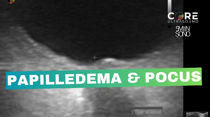 Diagnose Papilledema in Seconds with POCUS!