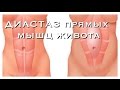 ДИАСТАЗ прямых мышц живота после РОДОВ!