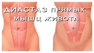 ДИАСТАЗ прямых мышц живота после РОДОВ!(, 2015-02-09T14:35:40.000Z)