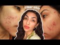 How I cleared my acne ✨ esthetician approved!