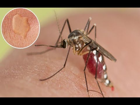 Punture delle zanzare: come sentire sollievo immediato in modo naturale