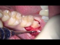 lower third molar extraction