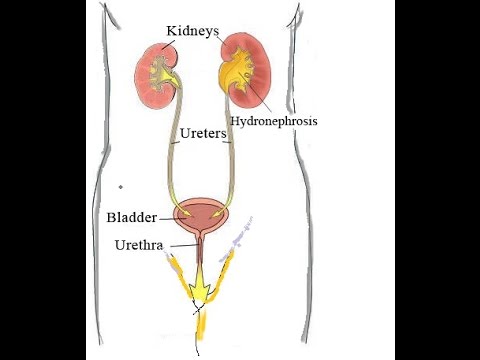 How is a ureteric stent put into place?