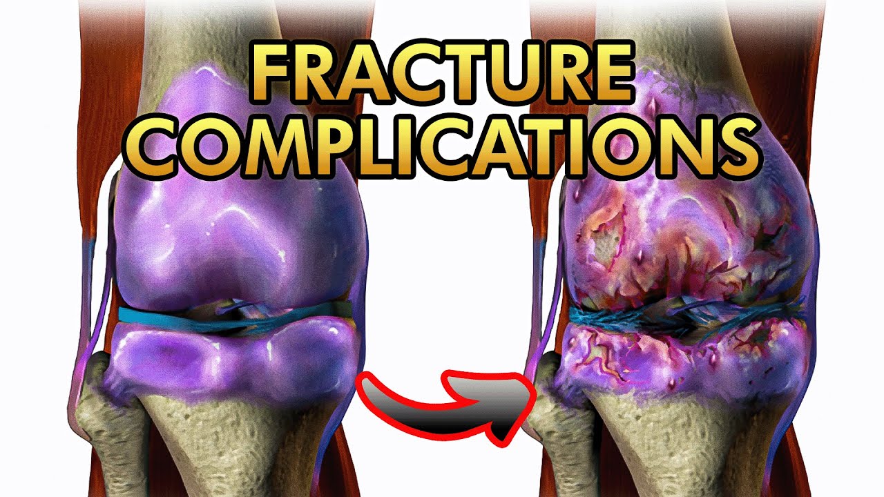 Complications of Fractures: Joint stiffness, Joint Instability and Osteoarthritis