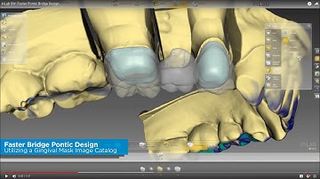 inLab SW: Faster Pontic Bridge Design