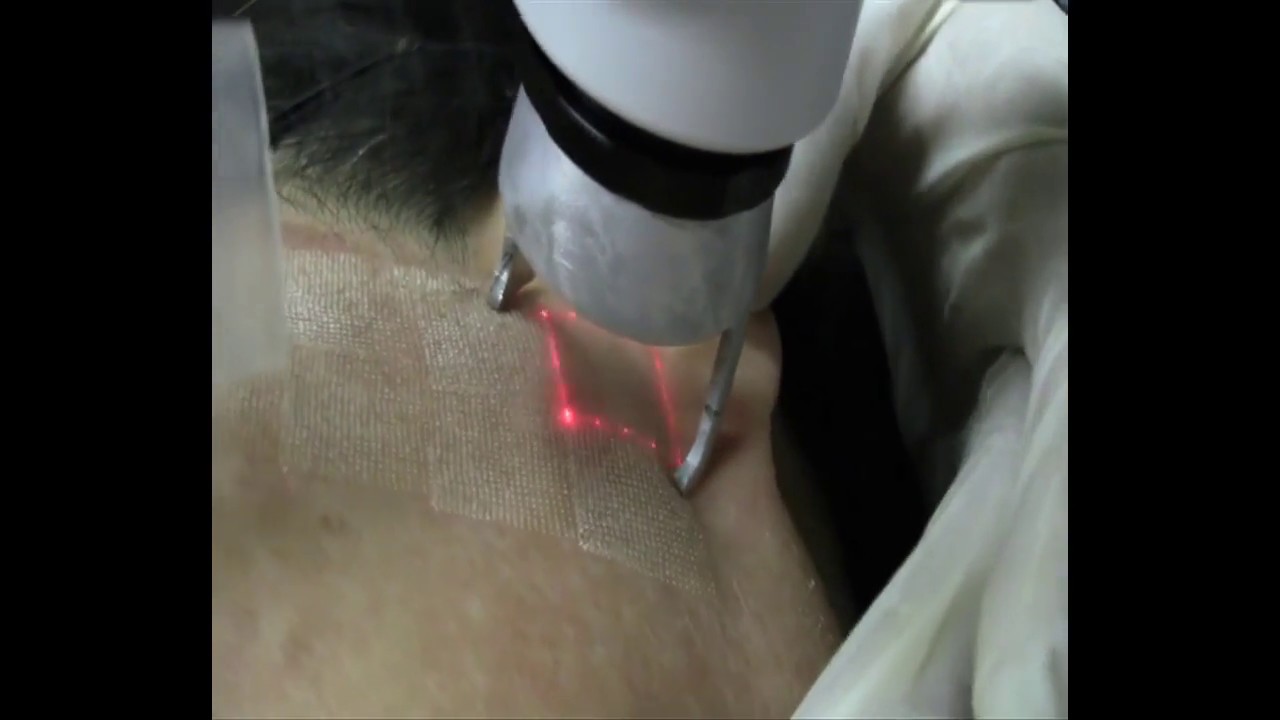 CO2 Matrix Laser with Dr. Philip Miller