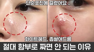 ENG)단순포진 걸렸어요..?원인,치료 그리고 예방법까지 이야기해볼까요??Most People Have Herpes Simplex virus