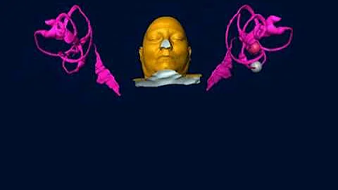 Brandt-Daroff Exercises For Horizontal and Posterior Canalithiasis