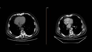 Renal neoplasm with vascular invasion