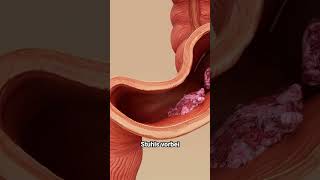 Mehrmals Täglich Stuhlgang? Das Kann Verstopfung Sein Nicht Durchfall.