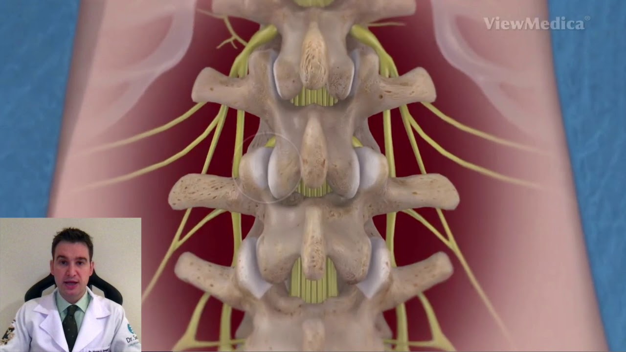 Cirurgia na Coluna Lombar - Artrodese Lombar TLIF e Parafusos