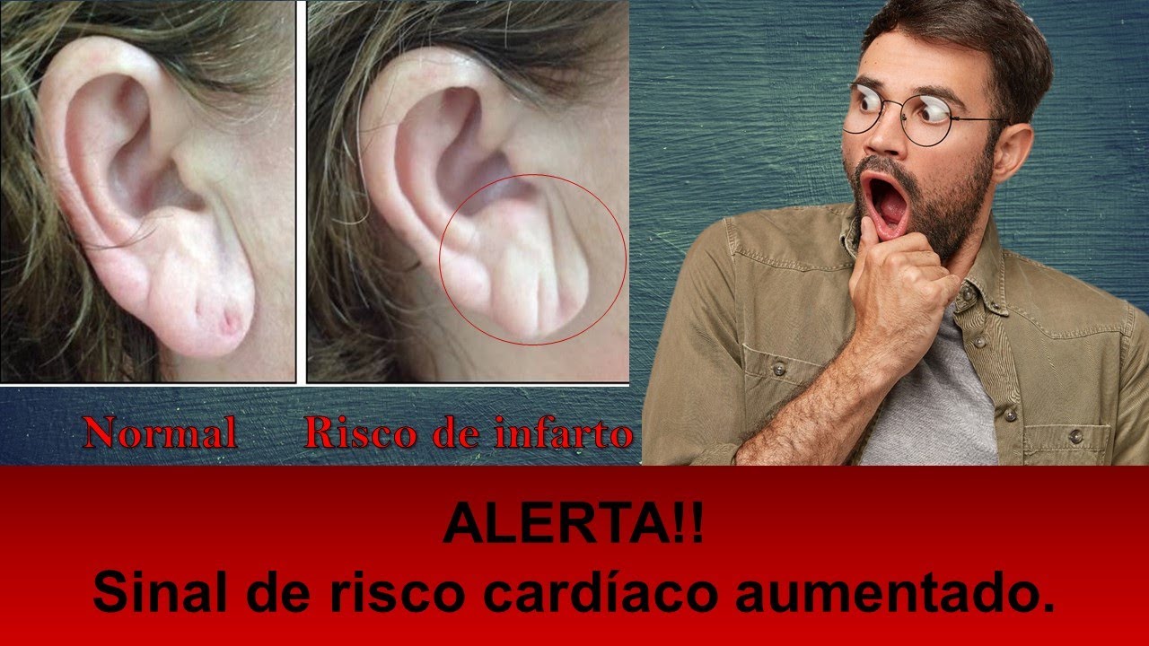 Alerta: Sinais de Infarto