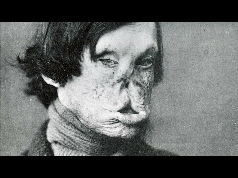 Самая уродливая болезнь. Почему ей все ещё можно заболеть.
