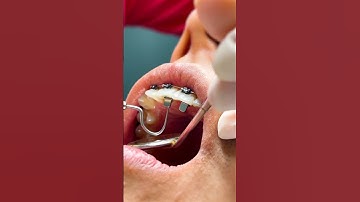 Si tienes Mordida Profunda esta es la mejor solución. #brackets #dientes #mordidaprofunda