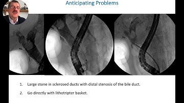 ERCP - Using the Lithotripter Stone Crushing Basket