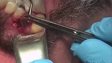Minimally-Invasive Posterior Socket Preservation: Case 3