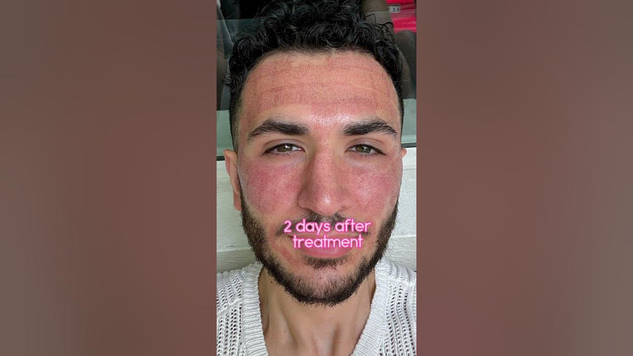 Co2 Laser results are wild