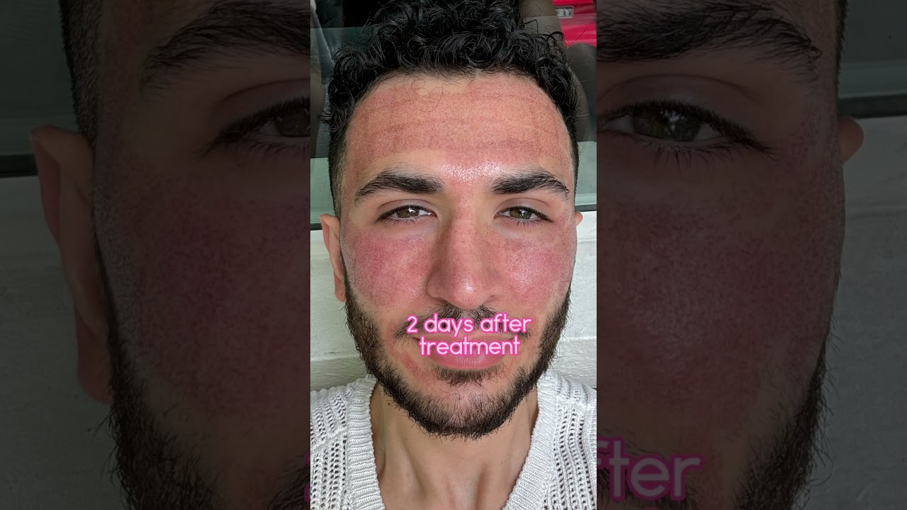 Co2 Laser results are wild