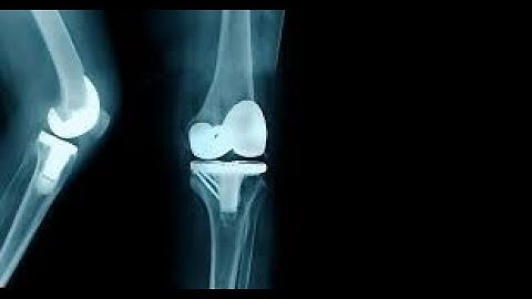 Arthroplasty Knee CPT code - simplify medical coding