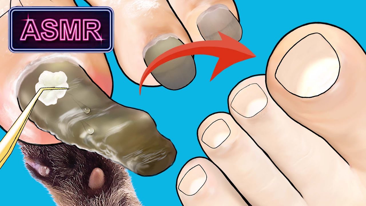[ASMR] Athlete's foot treatment animation/ Athlete's foot toenail care ...