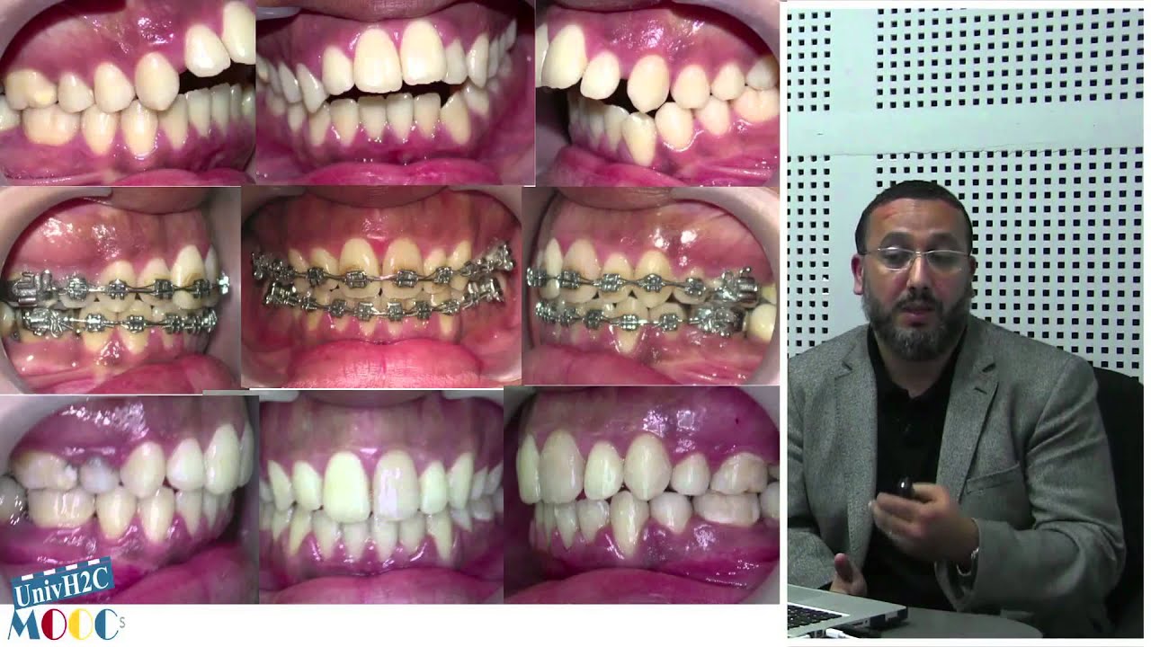 Introduction à l'orthodontie CH2