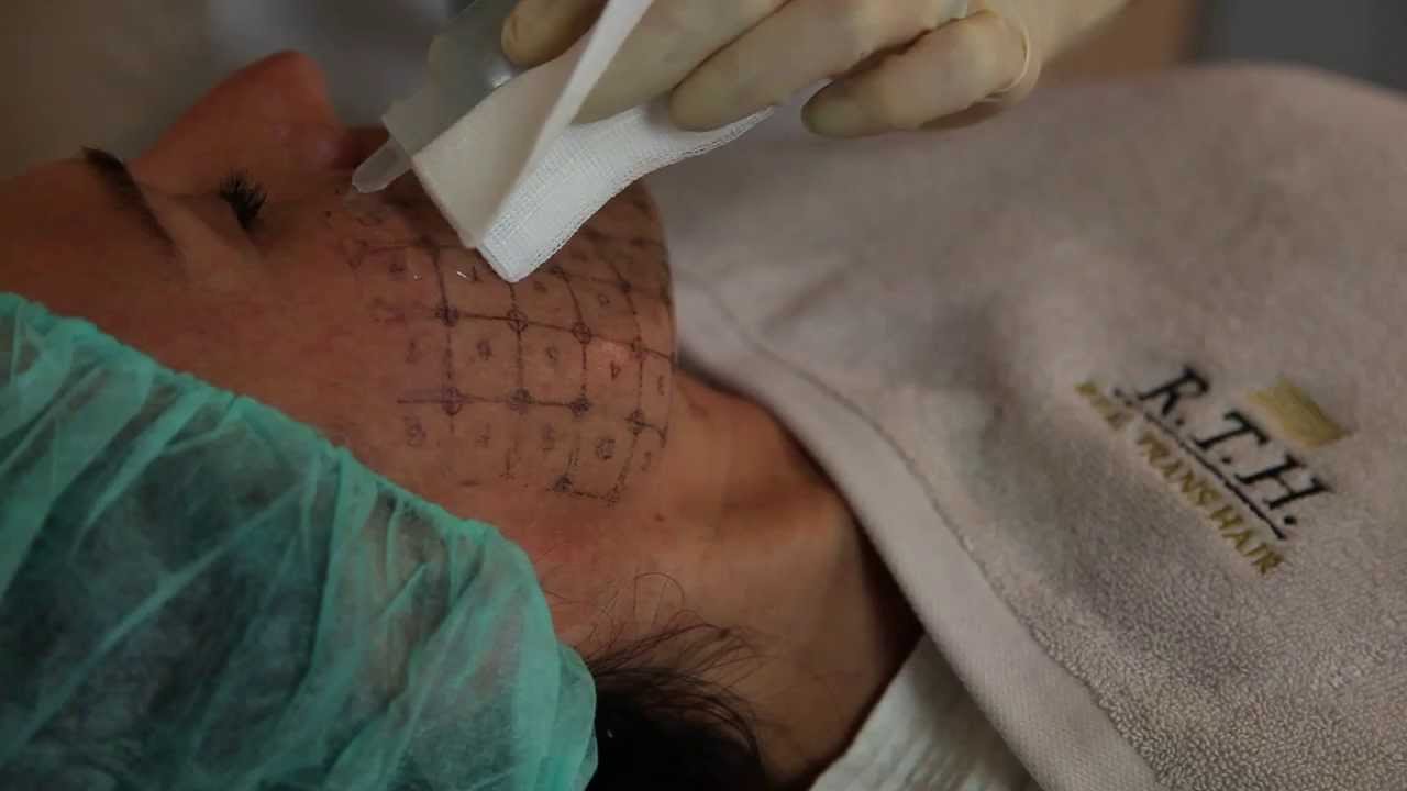 Что такое процедура термаж?