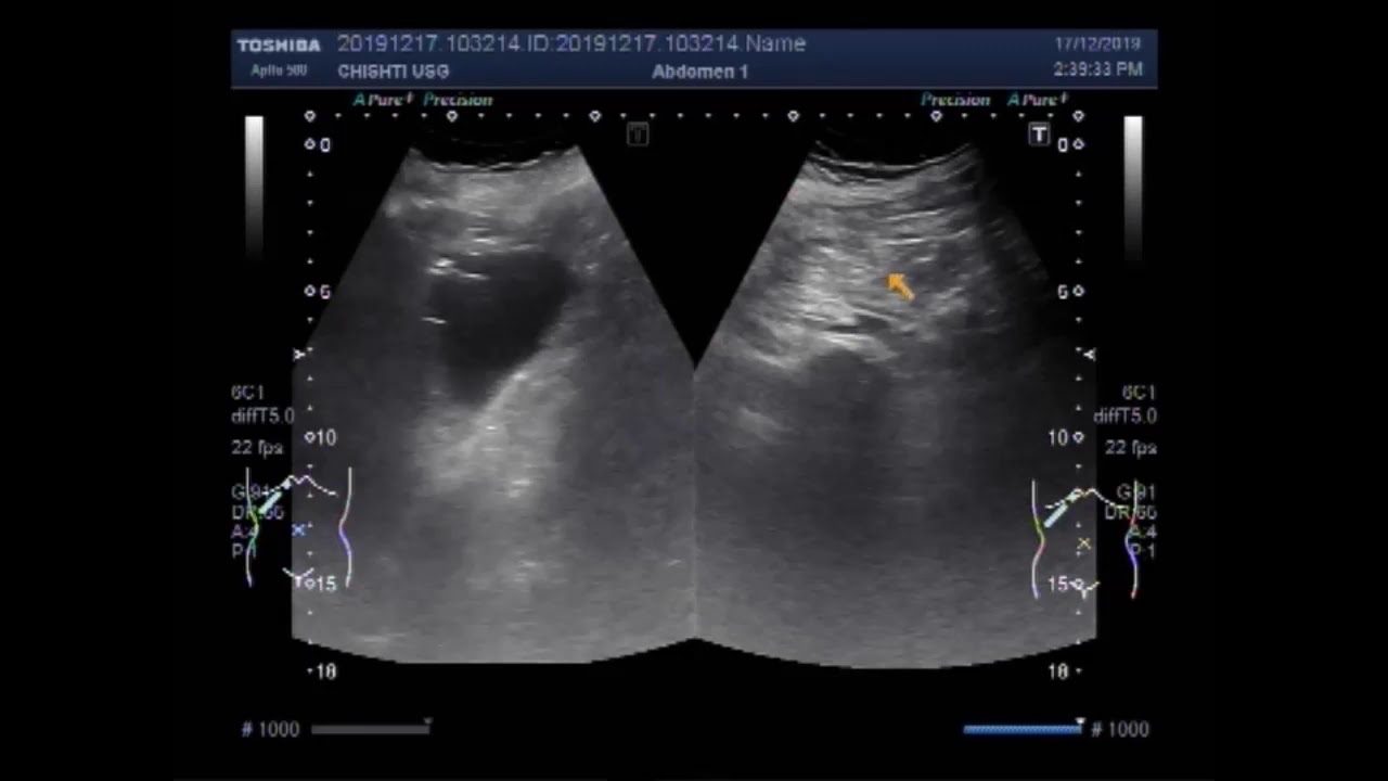 Ultrasound Video showing Hemoperitoneum / hematoperitoneum after 30 ...