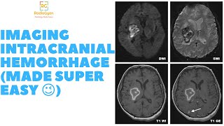 Brain Hemorrhage CT / MRI (Made Super Easy!) - Radiology Video Tutorial!