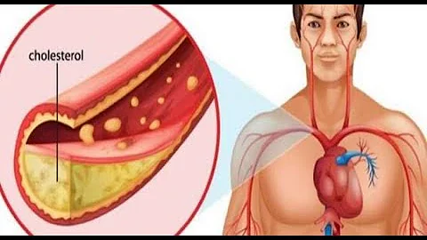 ¿Cómo quitar la acumulación de placas en las arterias?