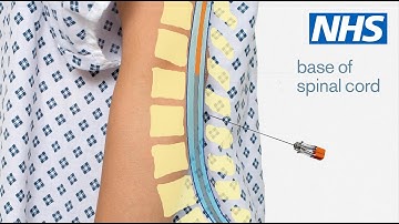 Having a lumbar puncture