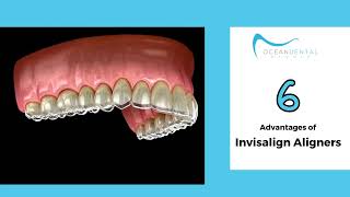 6 Advantages of Invisalign Aligners | Ocean Dental Studio
