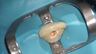 Obturation of maxillary central incisor