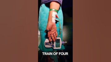 TRAIN OF FOUR NEUROMUSCULAR MONITORING