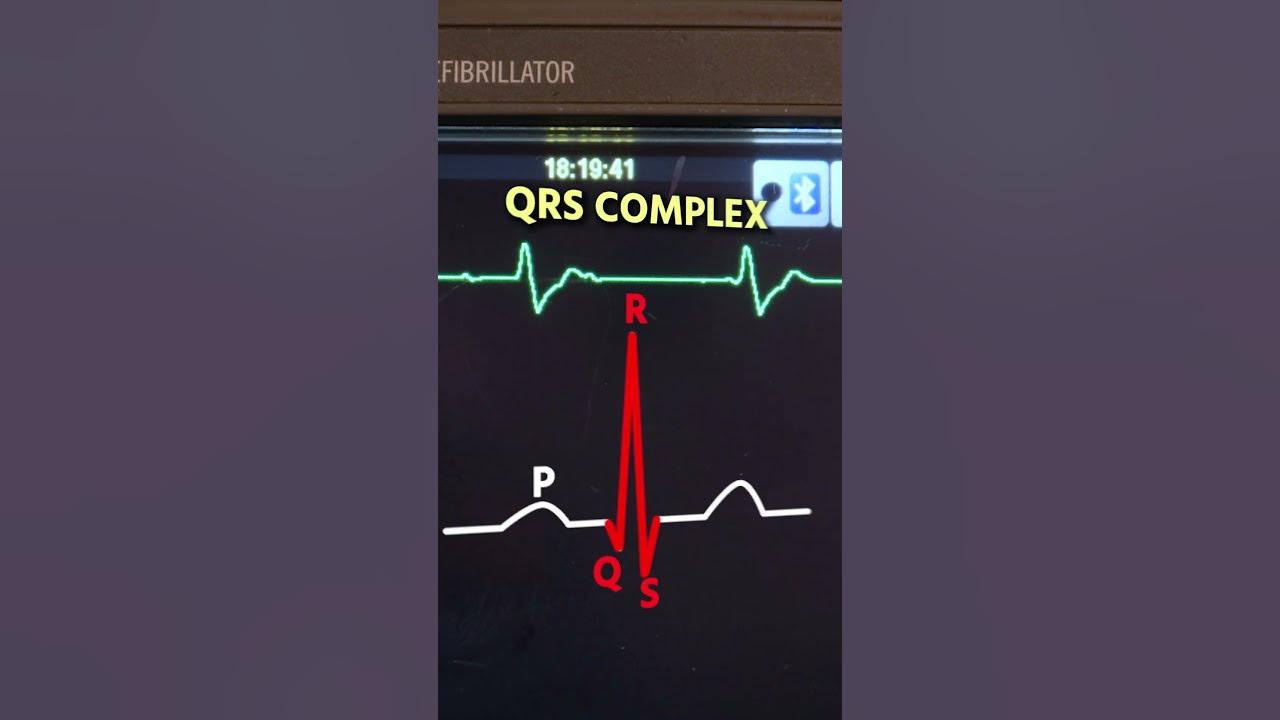 3rd DEGREE HEART BLOCK YouTube