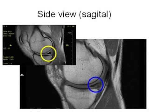 How to Read Knee MRI of Torn Meniscus | Meniscal Tear | Santa Fe, Albuquerque Orthopedic Surgeon