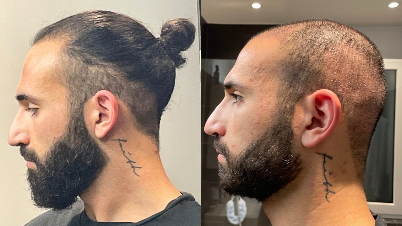 Почему я лысый после двух пересадок волос