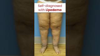 She selfdiagnosed with Lipedema. Were you too? #lipedema #shorts_feed